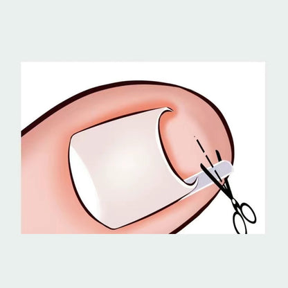 🔥LIMITED OFFER🔥Ingrown Toenail Treatment Corrector Set